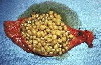 Click Here To See the NEXT image ( 1 ) ( Images: Gallbladder surgically removed - Cholelithiasis (Gallstones)<br>Gallbladder can hold one big or up to several thousand small stones. If not treated, stones may grow, or stones may clump together and form one huge stone.) 