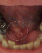 Swollen Glands Under Tongue