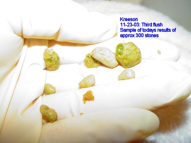 Click Here To See the NEXT image ( 7 ) (Results of my second Liver Flush ... cholesterol stones ... ) 