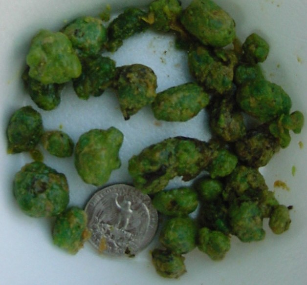 Click Here To See the NEXT image ( 7 ) (<br>flowerchild59: Stones I got on my 2nd liver flush) 