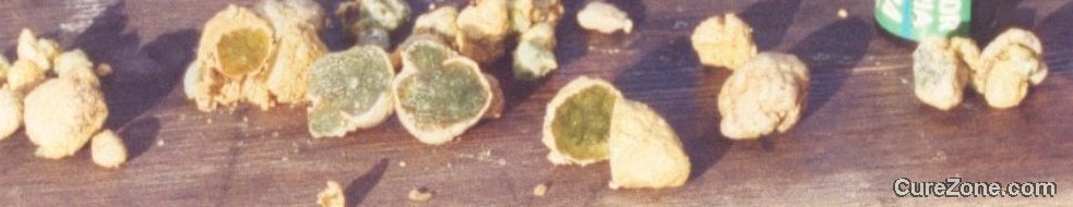 Click Here To See the NEXT image ( 38 ) (Cholesterol Stones collected after a Liver Cleanse or a liver flush or a gallbaldder cleanse flush<br>Look at the bottom of this page to find links to different recipes for cleansing Liver & gallbladder) 