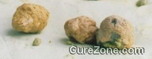 Click Here To See the NEXT image ( 41 ) (Cholesterol Stones collected after a Liver Cleanse or a liver flush or a gallbaldder cleanse flush<br>Look at the bottom of this page to find links to different recipes for cleansing Liver & gallbladder) 