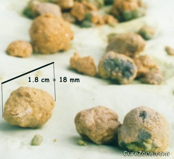 Click Here To See the NEXT image ( 42 ) (Cholesterol Stones collected after a Liver Cleanse or a liver flush or a gallbaldder cleanse flush<br>Look at the bottom of this page to find links to different recipes for cleansing Liver & gallbladder) 