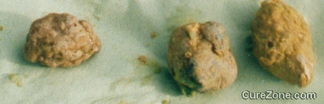 Click Here To See the NEXT image ( 44 ) (Cholesterol Stones collected after a Liver Cleanse or a liver flush or a gallbaldder cleanse flush<br>Look at the bottom of this page to find links to different recipes for cleansing Liver & gallbladder) 