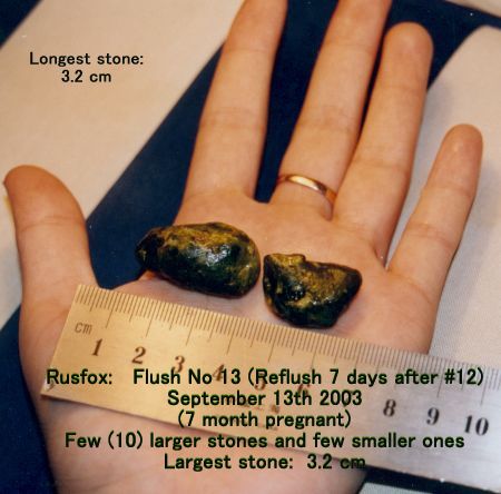 Click Here To See the NEXT image ( 4 ) (Rusfox: My photos of the *stones* I got on my 11th, 12th and 13th liver flush, while 5 and 7 months pregnant (Stones are not calcified)) 