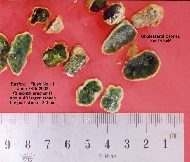 Click Here To See the NEXT image ( 8 ) (Rusfox: My photos of the *stones* I got on my 11th, 12th and 13th liver flush, while 5 and 7 months pregnant (Stones are not calcified)) 