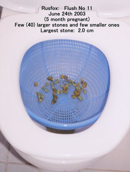 Click Here To See the NEXT image ( 0 ) (Rusfox: My photos of the *stones* I got on my 11th, 12th and 13th liver flush, while 5 and 7 months pregnant (Stones are not calcified)) 