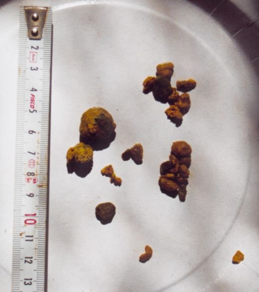 Click Here To See the NEXT image ( 7 ) (Liver Stones and Gallstones - Results of Liver Cleanse - Flush and Gallbladder Cleanse<br>Look at the bottom of this page to find links to different recipes for cleansing Liver & gallbladder) 