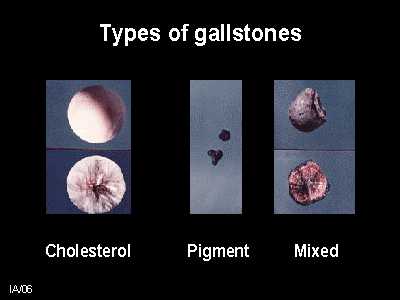 Click Here To See the NEXT image ( 11 ) (Liver Stones and Gallstones - Results of Liver Cleanse - Flush and Gallbladder Cleanse<br>Look at the bottom of this page to find links to different recipes for cleansing Liver & gallbladder) 