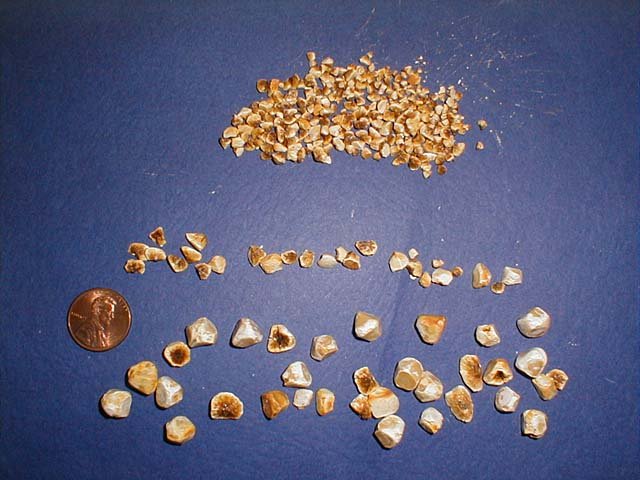 Click Here To See the NEXT image ( 3 ) ( Polyhedra faceted calcified gallstones - Calcified Stones taken out from surgically removed gallbladder.) 