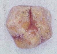 Click Here To See the NEXT image ( 7 ) ( Mercedes gallstone - Calcified Stone taken out from surgically removed gallbladder. ) 