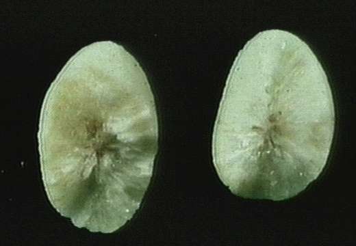 Click Here To See the NEXT image ( 11 ) ( Cholelithiasis, Cholesterol Stones. Cholesterol stones tend to be large, round to ovoid. The stones are usually pale yellow colored, althought this stone appears white. On sectioning, the crystalline radiating pattern can be appreciated.) 