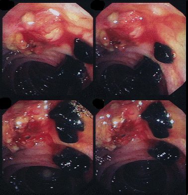 Click Here To See the NEXT image ( 16 ) ( Gallstones) 