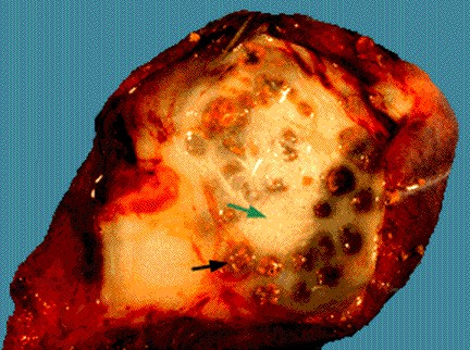 Click Here To See the NEXT image ( 23 ) ( Gallstones & Gallbladder ) 