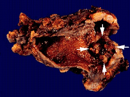 Click Here To See the NEXT image ( 27 ) ( Images: Gallbladder surgically removed - Cholelithiasis (Gallstones)<br>Gallbladder can hold one big or up to several thousand small stones. If not treated, stones may grow, or stones may clump together and form one huge stone.) 