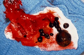 Click Here To See the NEXT image ( 29 ) ( Images: Gallbladder surgically removed - Cholelithiasis (Gallstones)<br>Gallbladder can hold one big or up to several thousand small stones. If not treated, stones may grow, or stones may clump together and form one huge stone.) 