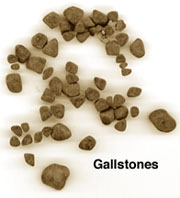 Click Here To See the NEXT image ( 34 ) ( Images: Gallbladder surgically removed - Cholelithiasis (Gallstones)<br>Gallbladder can hold one big or up to several thousand small stones. If not treated, stones may grow, or stones may clump together and form one huge stone.) 