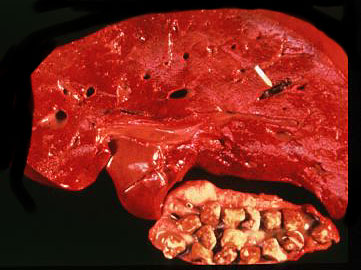 Click Here To See the NEXT image ( 36 ) ( Images: Gallbladder surgically removed - Cholelithiasis (Gallstones)<br>Gallbladder can hold one big or up to several thousand small stones. If not treated, stones may grow, or stones may clump together and form one huge stone.) 