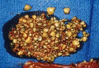 Click Here To See the NEXT image ( 38 ) ( Images: Gallbladder surgically removed - Cholelithiasis (Gallstones)<br>Gallbladder can hold one big or up to several thousand small stones. If not treated, stones may grow, or stones may clump together and form one huge stone.) 