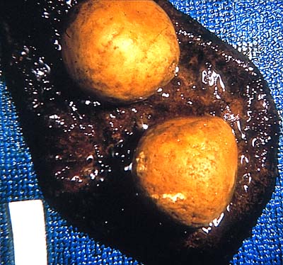 Click Here To See the NEXT image ( 41 ) ( Images: Gallbladder surgically removed - Cholelithiasis (Gallstones)<br>Gallbladder can hold one big or up to several thousand small stones. If not treated, stones may grow, or stones may clump together and form one huge stone.) 