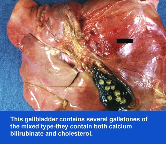 Click Here To See the NEXT image ( 43 ) ( Images: Gallbladder surgically removed - Cholelithiasis (Gallstones)<br>Gallbladder can hold one big or up to several thousand small stones. If not treated, stones may grow, or stones may clump together and form one huge stone.) 