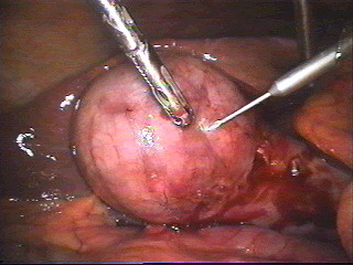 Click Here To See the NEXT image ( 0 ) ( Images: Gallbladder surgically removed - Cholelithiasis (Gallstones)<br>Gallbladder can hold one big or up to several thousand small stones. If not treated, stones may grow, or stones may clump together and form one huge stone.) 