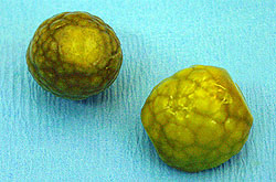 Click Here To See the NEXT image ( 10 ) ( Gallstones Surgically Removed / Gallbladder Surgerically Removed / Laparoscopic Cholecystectomy / Gallbladder Surgery ...  Images courtesy of chir.ch) 