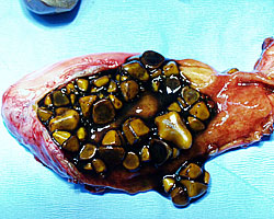 gallbladder surgically removed