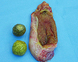 gallbladder surgically removed