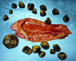 gallbladder surgically removed