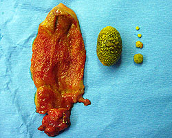 gallbladder surgically removed