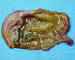 gallbladder surgically removed