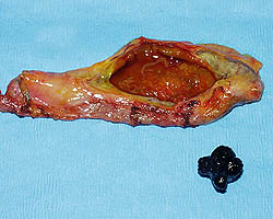 gallbladder surgically removed