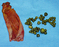 gallbladder surgically removed