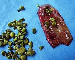 gallbladder surgically removed