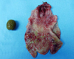 gallbladder surgically removed