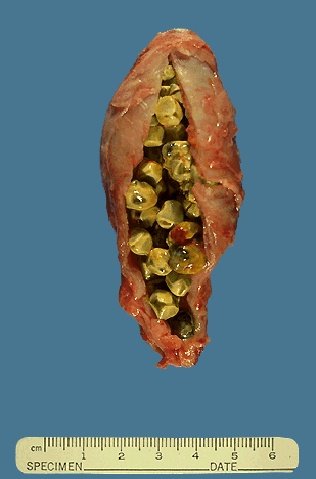 Click Here To See the NEXT image ( 47 ) ( Gallstones Surgically Removed / Gallbladder Surgerically Removed / Laparoscopic Cholecystectomy / Gallbladder Surgery ) 