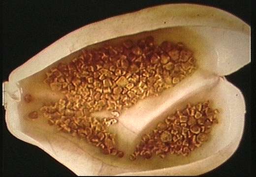 Click Here To See the NEXT image ( 49 ) ( Gallstones Surgically Removed / Gallbladder Surgerically Removed / Laparoscopic Cholecystectomy / Gallbladder Surgery ) 