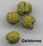 Click Here To See the NEXT image ( 54 ) ( Gallstones Surgically Removed / Gallbladder Surgerically Removed / Laparoscopic Cholecystectomy / Gallbladder Surgery ) 