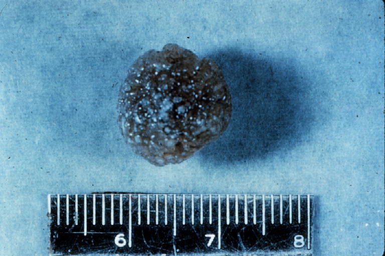 Click Here To See the NEXT image ( 6 ) (Intrahepatic Stones  - Liver - Bile Ducts, Stones Can be easily cleansed - Liver Cleanse - Flush) 