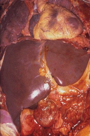 Click Here To See the NEXT image ( 12 ) (This is an in-situ photograph of the chest and abdominal contents. As can be seen, the liver is the largest parenchymal organ, lying just below the diaphragm. The right lobe (at the left in the photograph) is larger than the left lobe. The falciform ligament is the rough dividing line between the two lobes.) 