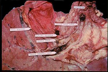 Click Here To See the NEXT image ( 0 ) (Intrahepatic Stones  - Liver - Bile Ducts, Stones Can be easily cleansed - Liver Cleanse - Flush) 