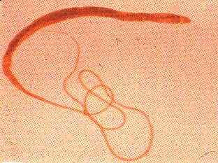 Click Here To See the NEXT image ( 55 ) ( Human Worms and other parasites ) 