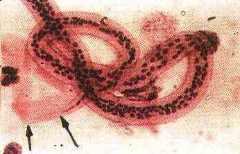 Click Here To See the NEXT image ( 58 ) ( Human Worms and other parasites ) 