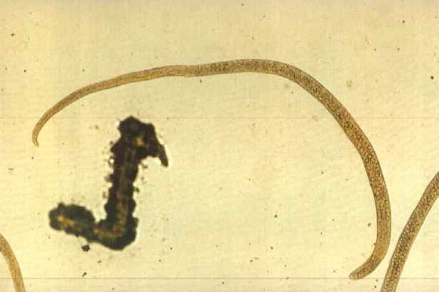 Click Here To See the NEXT image ( 62 ) ( Human Worms and other parasites ) 