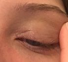 Eczema on eyelid #2