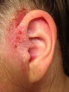 Eczema on left ear