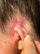 Eczema on and behind left ear