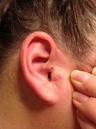 Eczema on right ear