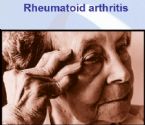 Autoimmune Diseases rheumatoid arthritis RA hand deformities symptoms 